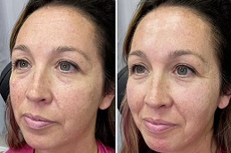 حشوات بيلوتيرو في الرياض والمملكة العربية السعودية