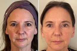 حشوات بيلوتيرو في الرياض