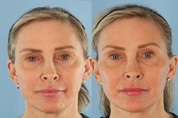 حشوات تحت العين في الرياض والمملكة العربية السعودية