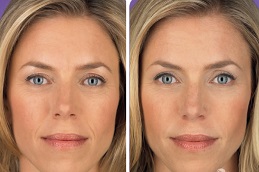 حشوات جوفيديرم في الرياض والمملكة العربية السعودية