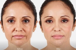 حشوات جوفيديرم في الرياض