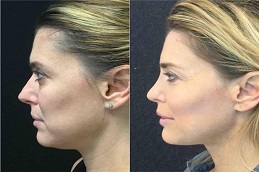 حشوات راديس في الرياض والمملكة العربية السعودية