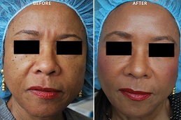 حشوات راديس في الرياض