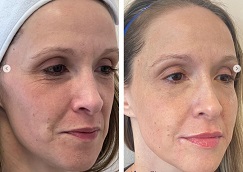 حشوات سكلبترا في الرياض