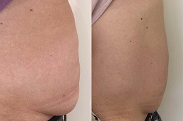 حقن أكواليكس في الرياض والمملكة العربية السعودية