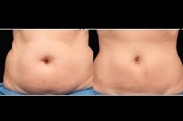 حقن إذابة الدهون في الرياض والمملكة العربية السعودية