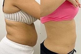 حقن إذابة الدهون في الرياض