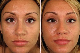 حقن البلازما الغنية بالصفائح الدموية في الرياض والمملكة العربية السعودية