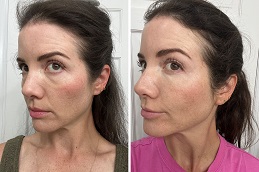 حقن البلازما الغنية بالصفائح الدموية في الرياض