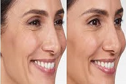 حقن البوتوكس للتجاعيد في الرياض والمملكة العربية السعودية