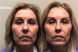 حقن البوتوكس للتجاعيد في الرياض