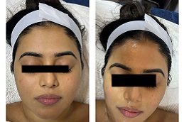 حقن الجلوتاثيون في الرياض والمملكة العربية السعودية