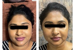 حقن الجلوتاثيون في الرياض