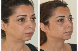 حقن حمض الهيالورونيك في الرياض