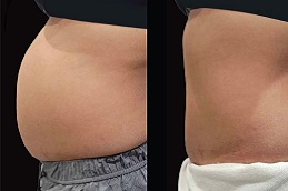 حقن ساكسيندا في الرياض والمملكة العربية السعودية