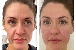 حقن سونيكوس في الرياض