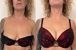 حقن فيلر الثدي في الرياض