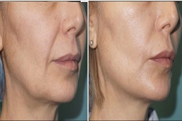 خيوط أبتوس في الرياض والمملكة العربية السعودية