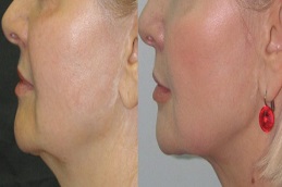 خيوط أبتوس في الرياض