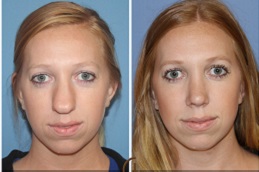 رأب الحاجز الأنفي وتقليص المحارة الأنفية في الرياض