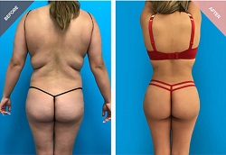 رفع المؤخرة البرازيلي في الرياض والمملكة العربية السعودية