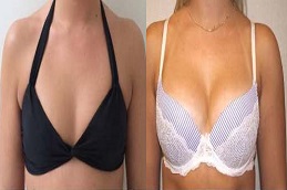 زراعة الثدي بالسيليكون في الرياض والمملكة العربية السعودية