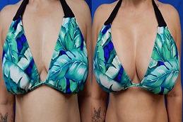 زراعة الثدي بالسيليكون في الرياض