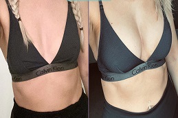 زراعة الثدي في موتيفا بالرياض والمملكة العربية السعودية