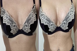 زراعة الثدي في موتيفا بالرياض