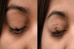 زراعة الرموش في الرياض والمملكة العربية السعودية