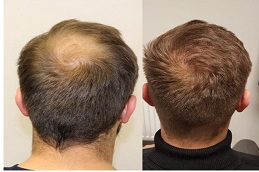 زراعة الشعر التاجي في الرياض