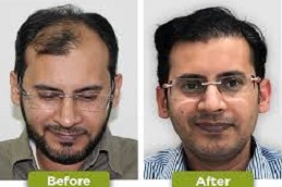 زراعة الشعر الهجين في الرياض والمملكة العربية السعودية