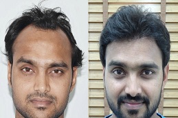 زراعة الشعر الهجين في الرياض