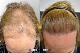 زراعة الشعر بالخلايا الجذعية في الرياض والمملكة العربية السعودية