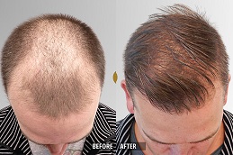 زراعة الشعر بالخلايا الجذعية في الرياض