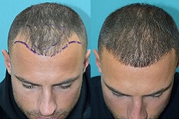زراعة الشعر بالروبوت في الرياض