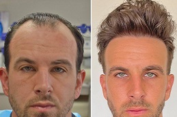 زراعة الشعر بتقنية الاقتطاف (FUE) في الرياض والمملكة العربية السعودية