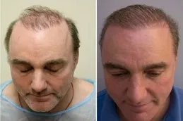 زراعة الشعر في بريدة والقصيم