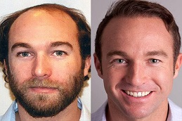 زراعة الشعر للرجال في الرياض والمملكة العربية السعودية