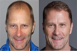 زراعة الشعر للرجال في الرياض