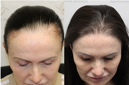 زراعة الشعر للنساء في الرياض والمملكة العربية السعودية