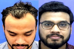 زراعة شعر الجسم في الرياض