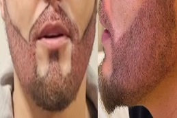 زراعة شعر اللحية في الرياض