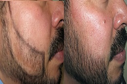 زراعة شعر اللحية في الرياض والمملكة العربية السعودية