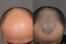 زراعة شعر بدون ندوب في الرياض