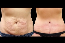 شد البطن المصغر في الرياض والمملكة العربية السعودية