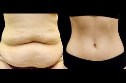 شد البطن المصغر في الرياض