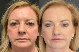 شد الجبين في الرياض والمملكة العربية السعودية