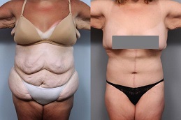 شد الجسم في الرياض