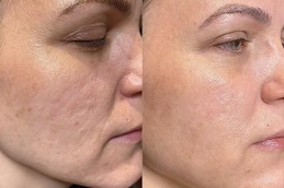 شد الجلد وتحديده في الرياض والمملكة العربية السعودية